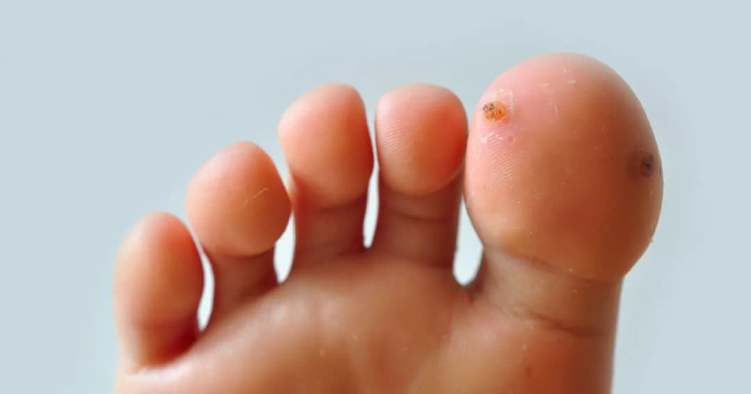 Kurzajki u dzieci na stopach: skuteczne sposoby leczenia bez stresu