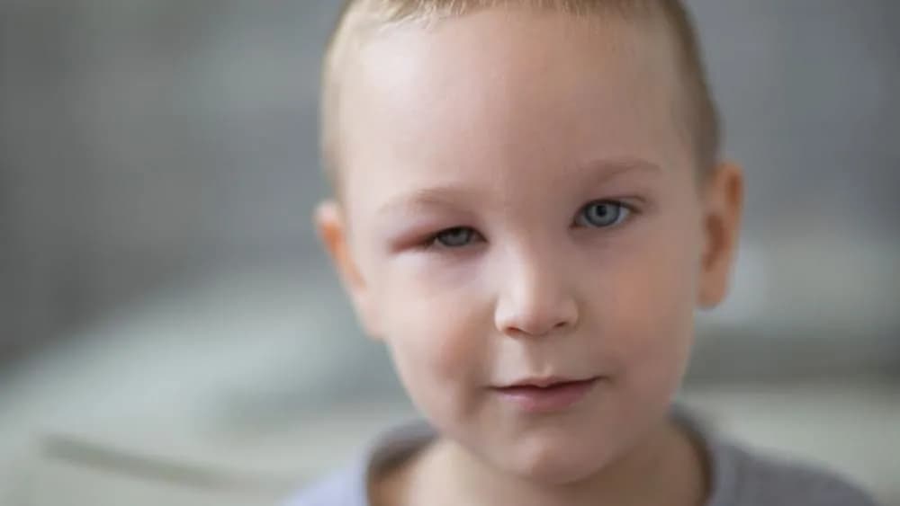 Opuchnięte oko u dziecka: Skuteczne sposoby pomocy i objawy, które zaskoczyć mogą rodziców